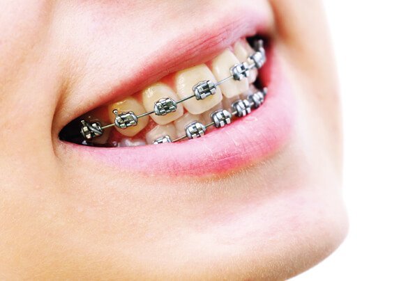 Orthodontic Treatment