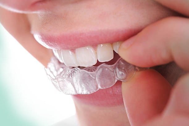 Clear Aligners