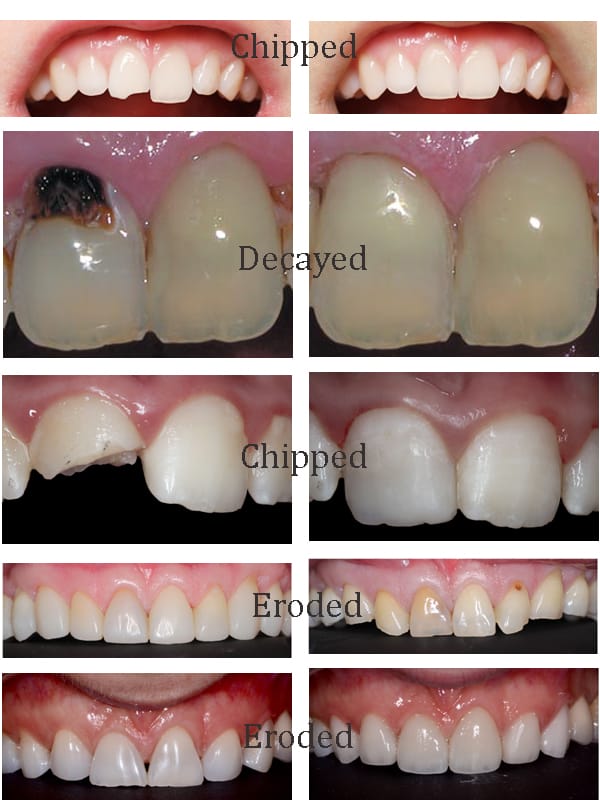 Cosmetic Dental Treatment (Composite Restoration)