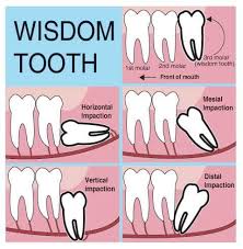 Dental Extractions & Minor Oral Surgery